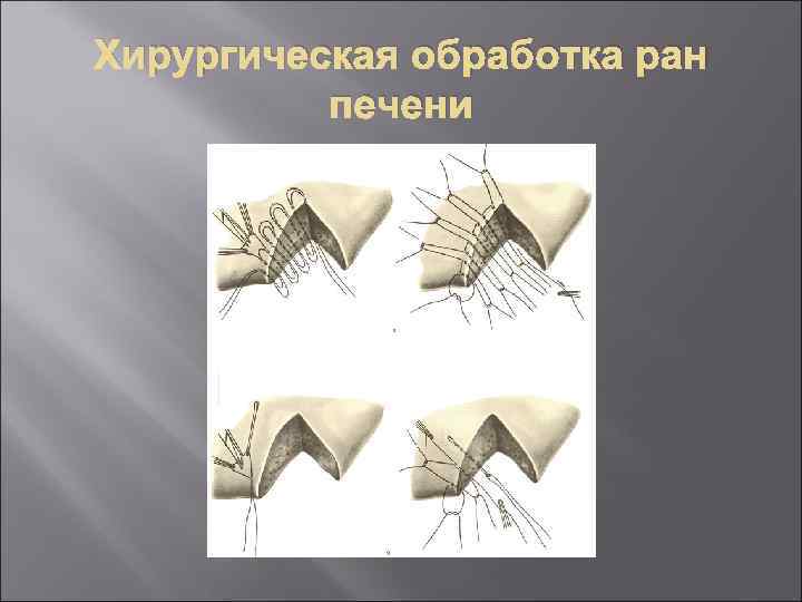 Хирургическая обработка ран печени 