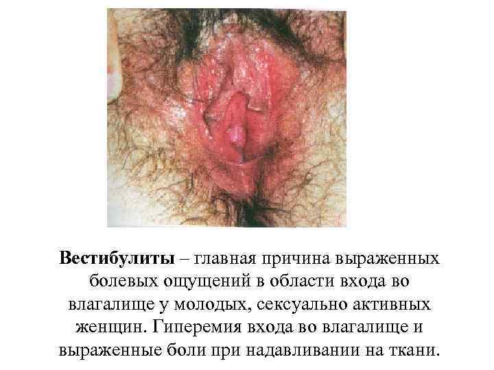 Вестибулиты – главная причина выраженных болевых ощущений в области входа во влагалище у молодых,