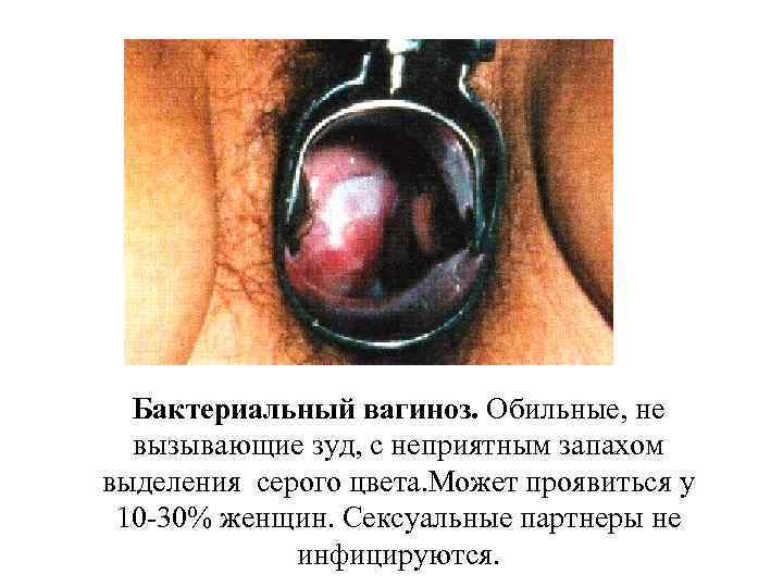 Бактериальный вагиноз. Обильные, не вызывающие зуд, с неприятным запахом выделения серого цвета. Может проявиться