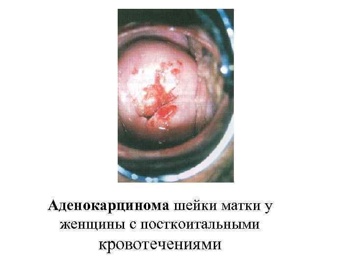 Аденокарцинома шейки матки у женщины с посткоитальными кровотечениями 