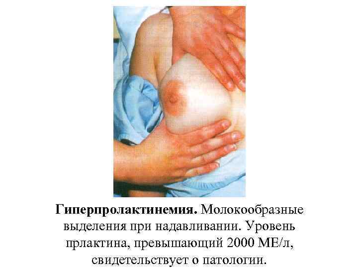 Гиперпролактинемия. Молокообразные выделения при надавливании. Уровень прлактина, превышающий 2000 МЕ/л, свидетельствует о патологии. 