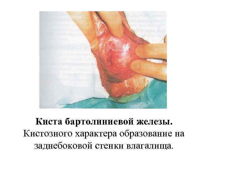 Киста бартолиниевой железы. Кистозного характера образование на заднебоковой стенки влагалища. 