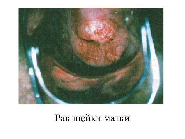 Рак шейки матки 