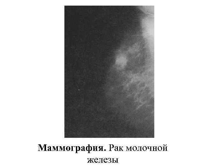 Маммография. Рак молочной железы 