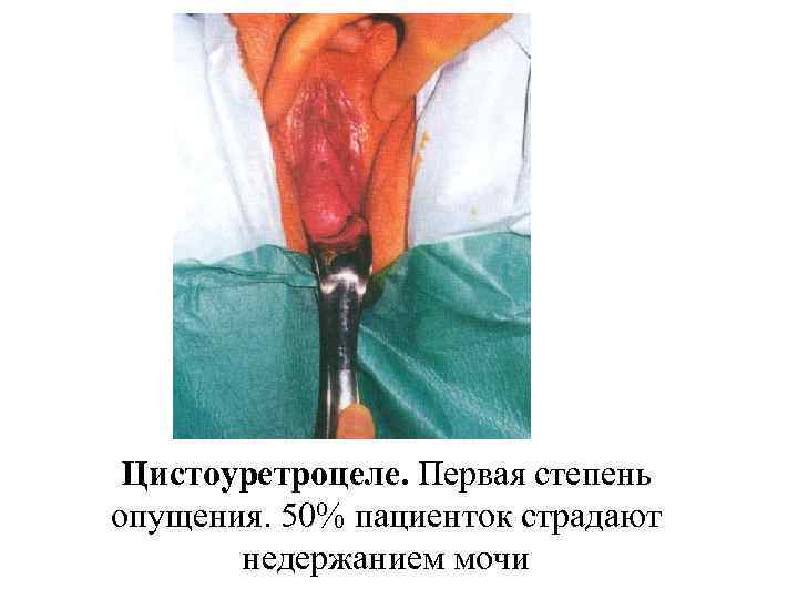 Цистоуретроцеле. Первая степень опущения. 50% пациенток страдают недержанием мочи 