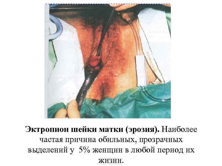 Эктропион шейки матки (эрозия). Наиболее частая причина обильных, прозрачных выделений у 5% женщин в