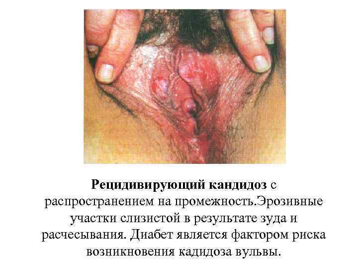 Рецидивирующий кандидоз с распространением на промежность. Эрозивные участки слизистой в результате зуда и расчесывания.