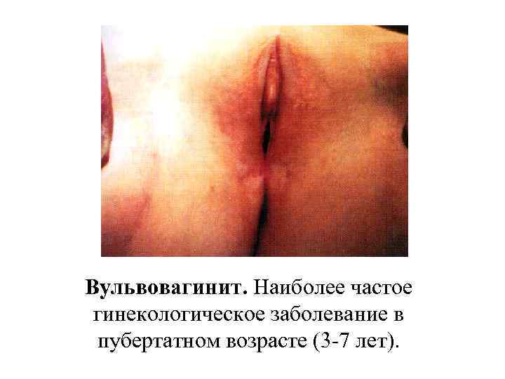Вульвовагинит. Наиболее частое гинекологическое заболевание в пубертатном возрасте (3 -7 лет). 