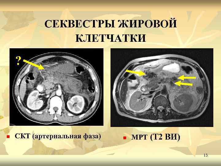 СЕКВЕСТРЫ ЖИРОВОЙ КЛЕТЧАТКИ ? n СКТ (артериальная фаза) ( n МРТ (Т 2 ВИ)