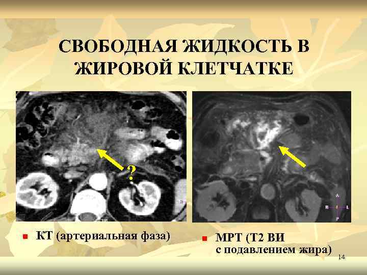 СВОБОДНАЯ ЖИДКОСТЬ В ЖИРОВОЙ КЛЕТЧАТКЕ ? n КТ (артериальная фаза) n МРТ (Т 2