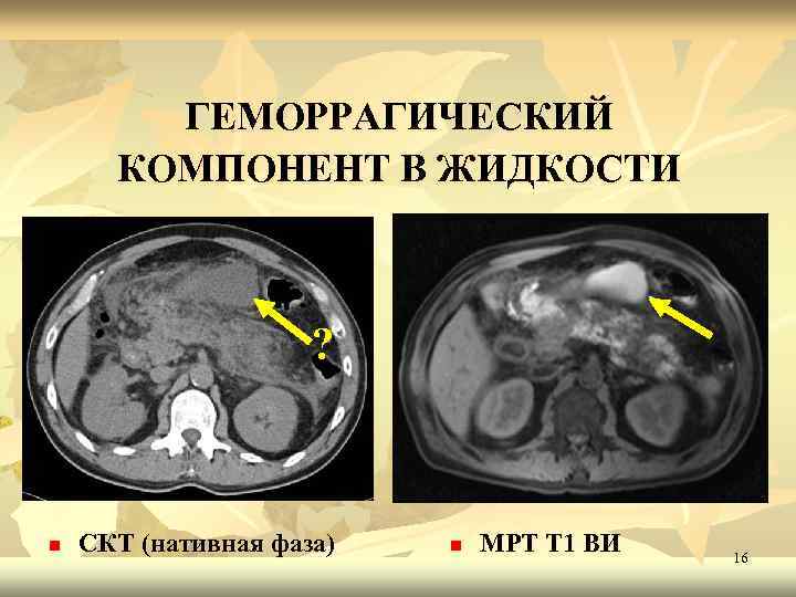 ГЕМОРРАГИЧЕСКИЙ КОМПОНЕНТ В ЖИДКОСТИ ? n СКТ (нативная фаза) n МРТ Т 1 ВИ