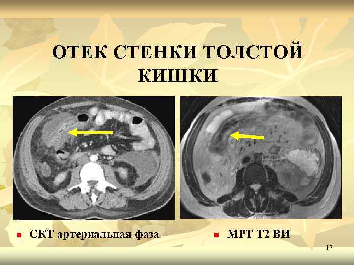 ОТЕК СТЕНКИ ТОЛСТОЙ КИШКИ n СКТ артериальная фаза n МРТ Т 2 ВИ 17