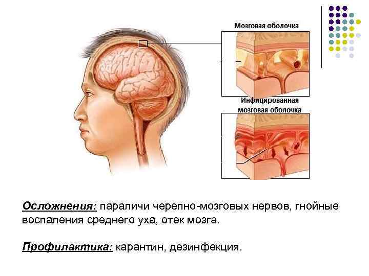 Осложнения: параличи черепно-мозговых нервов, гнойные воспаления среднего уха, отек мозга. Профилактика: карантин, дезинфекция. 