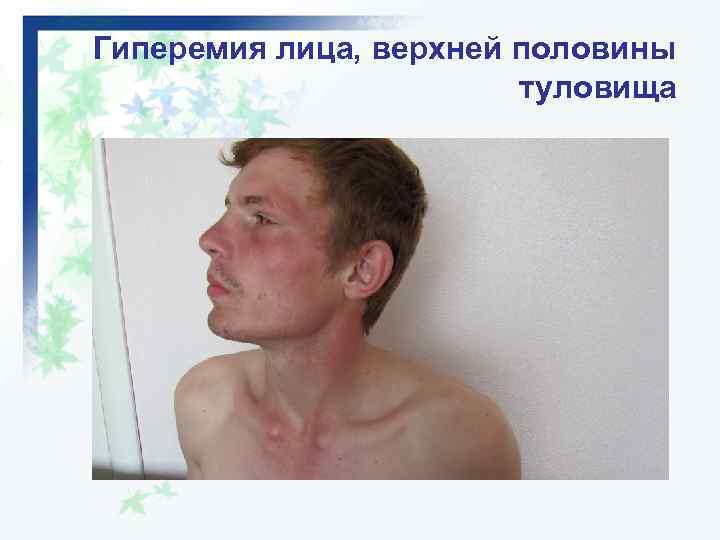 Гиперемия лица, верхней половины туловища 