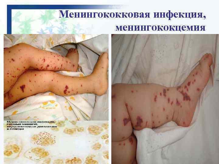 Менингококковая инфекция, менингококцемия 
