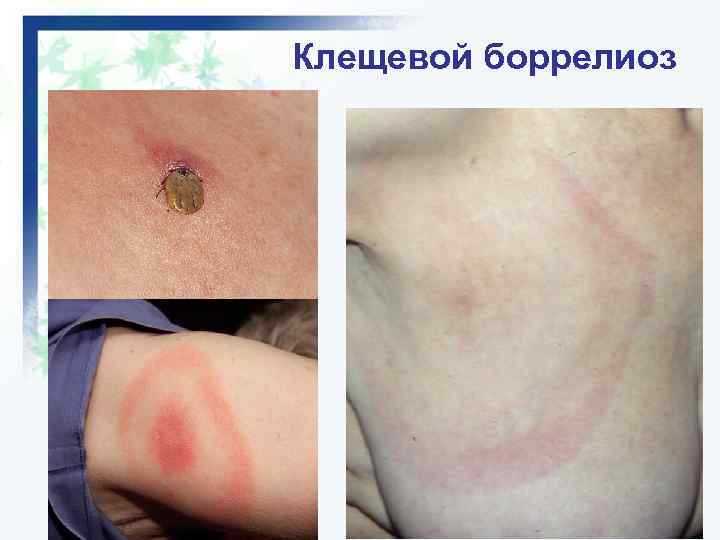 Клещевой боррелиоз фото больных