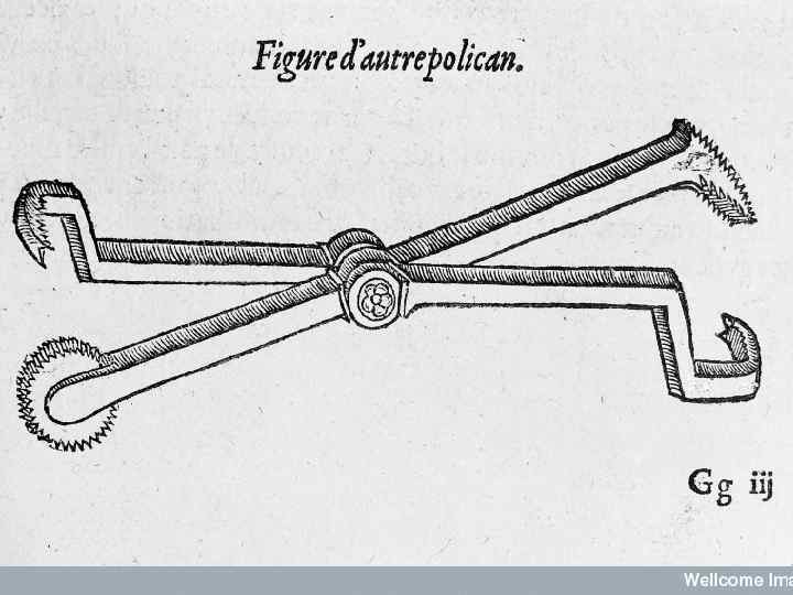 Развитие хирургии Переворот в хирургии связан с именем французского хирурга и акушера Амбруаза Паре
