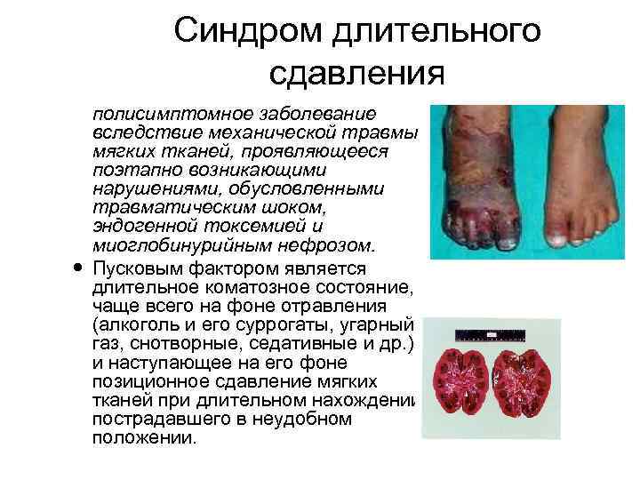 Синдром длительного сдавления полисимптомное заболевание вследствие механической травмы мягких тканей, проявляющееся поэтапно возникающими нарушениями,