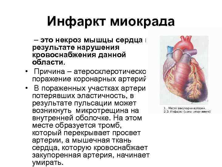 Инфаркт миокрада – это некроз мышцы сердца в результате нарушения кровоснабжения данной области. •