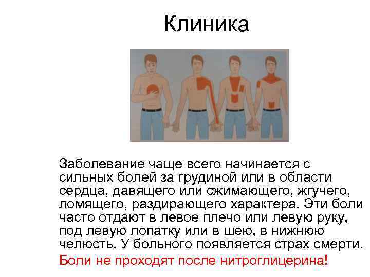 Клиника Заболевание чаще всего начинается с сильных болей за грудиной или в области сердца,