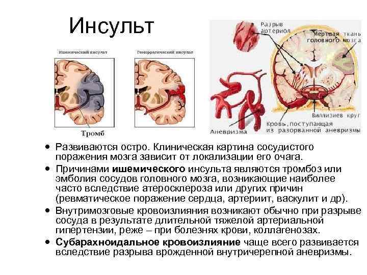 Инсульт Развиваются остро. Клиническая картина сосудистого поражения мозга зависит от локализации его очага. Причинами