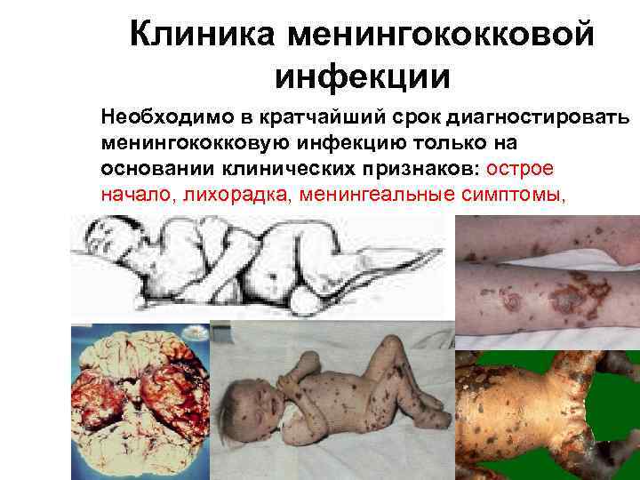 Клиника менингококковой инфекции Необходимо в кратчайший срок диагностировать менингококковую инфекцию только на основании клинических