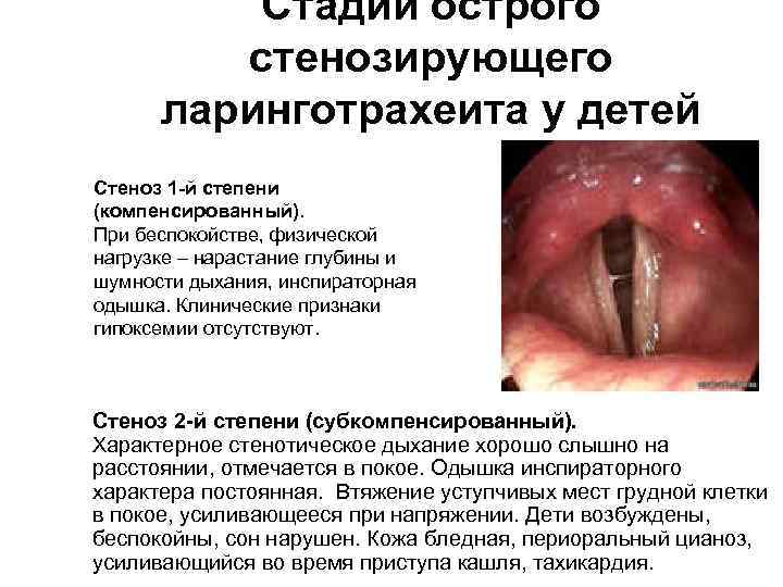 Стадии острого стенозирующего ларинготрахеита у детей Стеноз 1 -й степени (компенсированный). При беспокойстве, физической