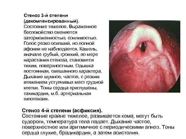 Стеноз 3 -й степени (декомпенсированный). Состояние тяжелое. Выраженное беспокойство сменяется заторможенностью, сонливостью. Голос резко