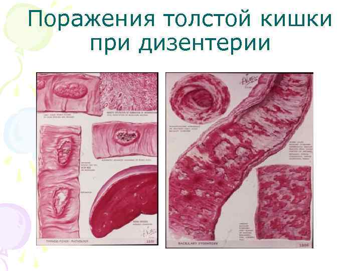 Поражения толстой кишки при дизентерии 