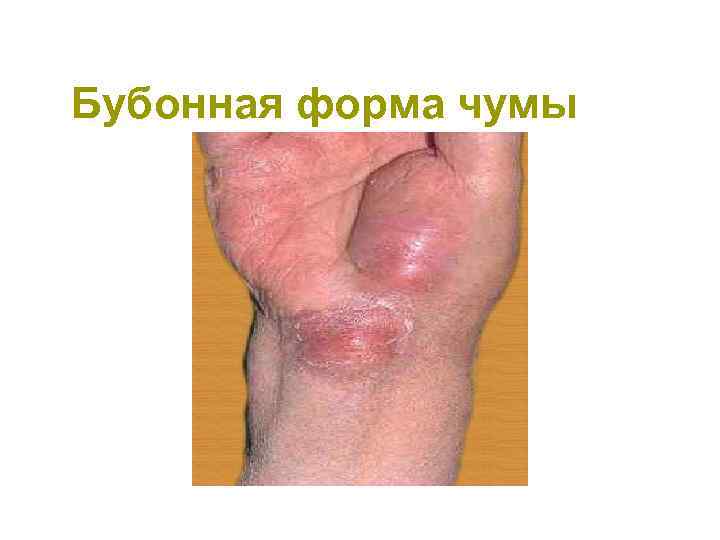 Бубонная форма чумы 