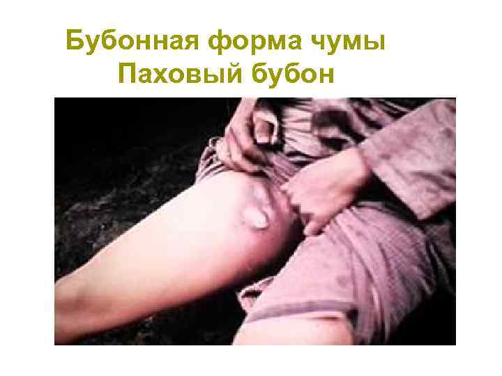 Бубонная форма чумы Паховый бубон 