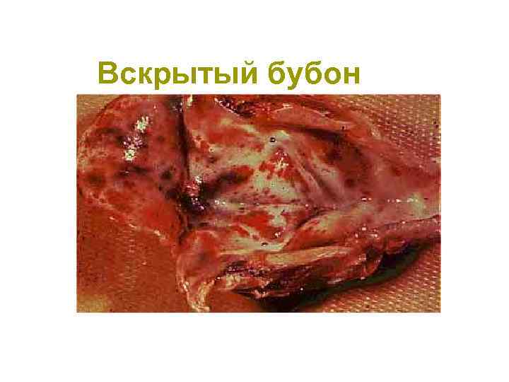 Вскрытый бубон 
