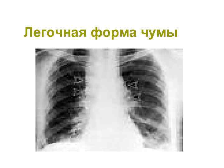 Легочная форма чумы 