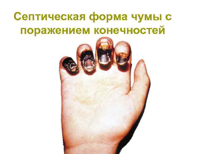 Септическая форма чумы с поражением конечностей 