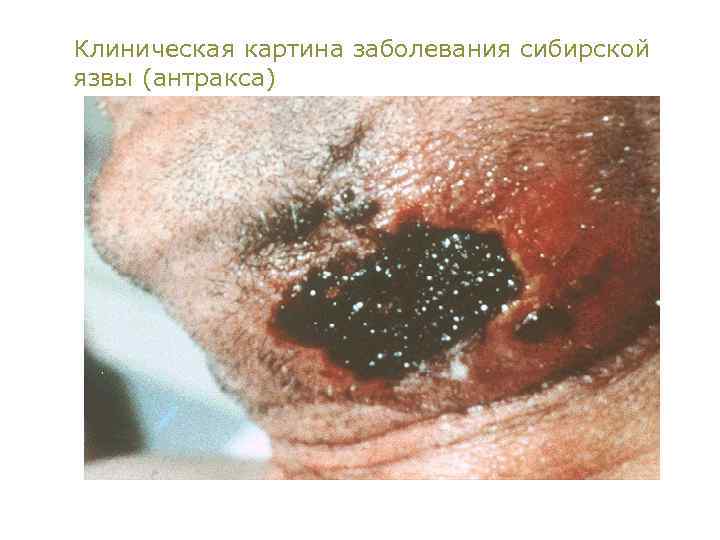 Клиническая картина заболевания сибирской язвы (антракса) 