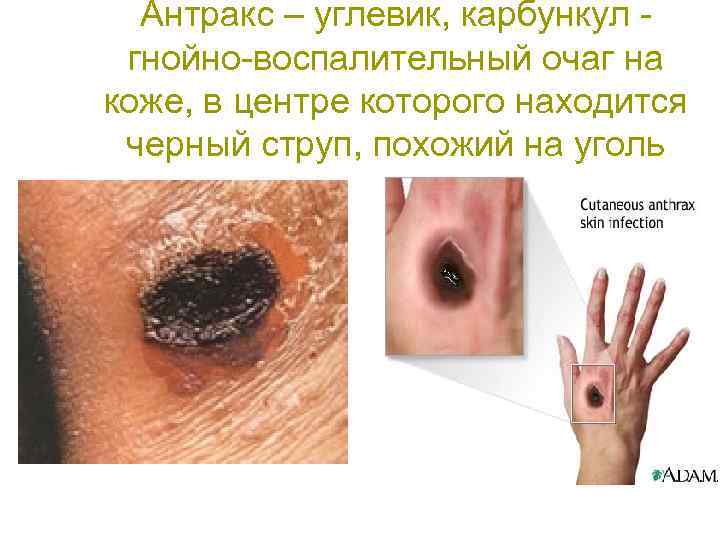 Антракс – углевик, карбункул гнойно-воспалительный очаг на коже, в центре которого находится черный струп,