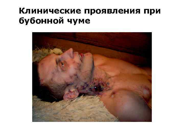 Клинические проявления при бубонной чуме 
