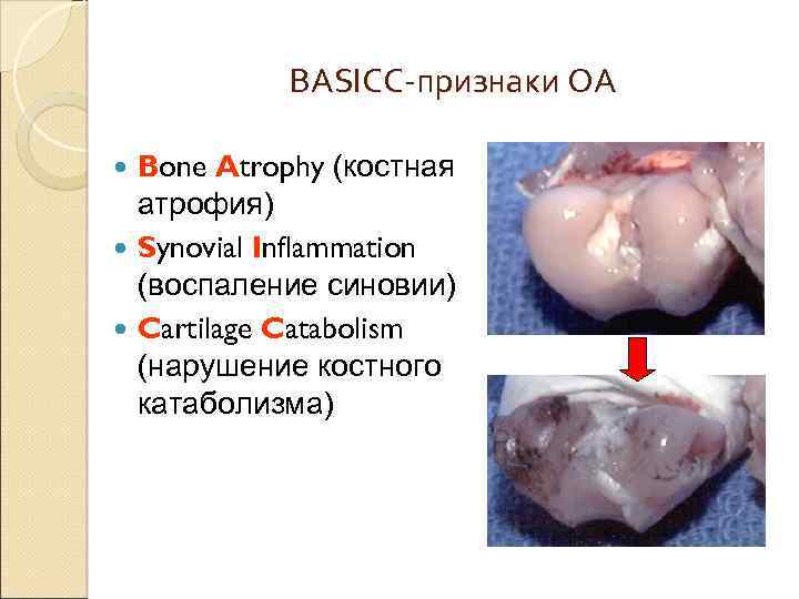BASICC-признаки ОА Bone Atrophy (костная атрофия) Synovial Inflammation (воспаление синовии) Cartilage Catabolism (нарушение костного