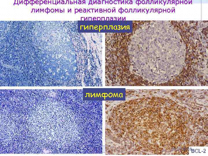 Дифференциальная диагностика фолликулярной лимфомы и реактивной фолликулярной гиперплазии гиперплазия лимфома 18 01. 02. 2018