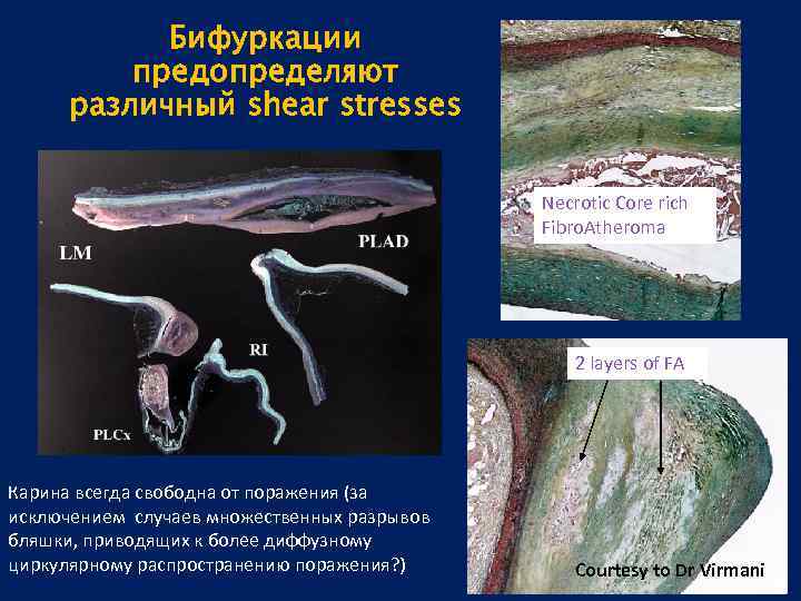 Бифуркации предопределяют различный shear stresses Necrotic Core rich Fibro. Atheroma 2 layers of FA
