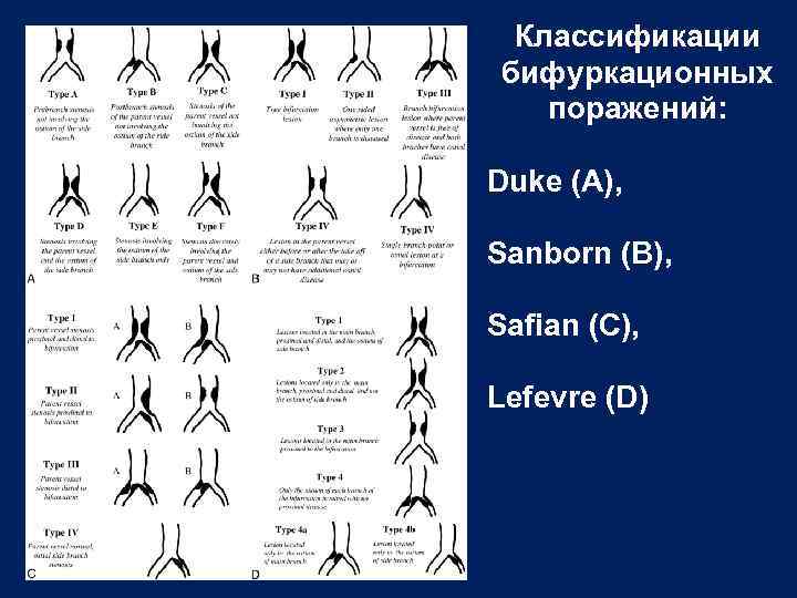 Классификации бифуркационных поражений: Duke (A), Sanborn (B), Safian (C), Lefevre (D) 