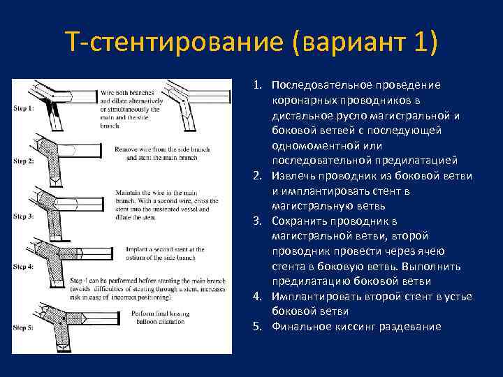 T-стентирование (вариант 1) 1. Последовательное проведение коронарных проводников в дистальное русло магистральной и боковой