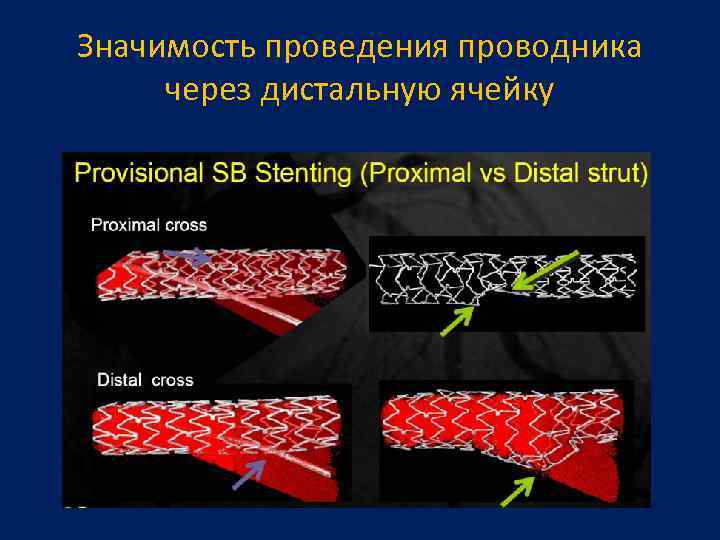 Значимость проведения проводника через дистальную ячейку 