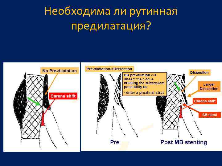 Необходима ли рутинная предилатация? 