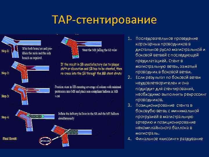 TAP-стентирование 1. Последовательное проведение коронарных проводников в дистальное русло магистральной и боковой ветвей с