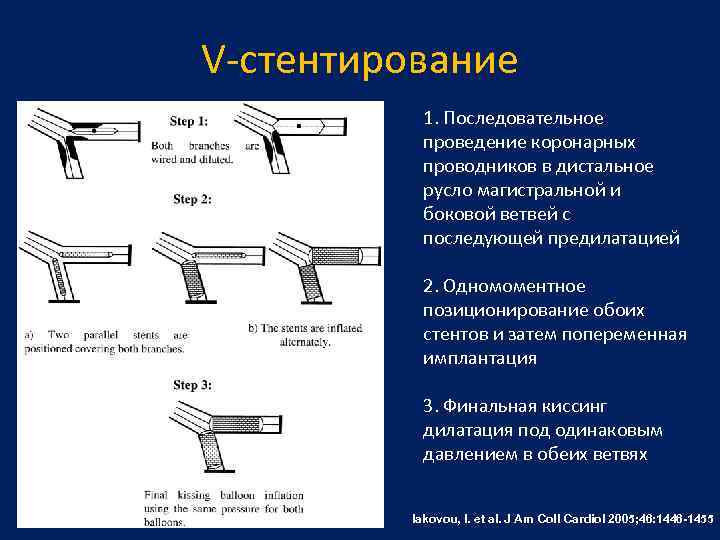 V-стентирование 1. Последовательное проведение коронарных проводников в дистальное русло магистральной и боковой ветвей с
