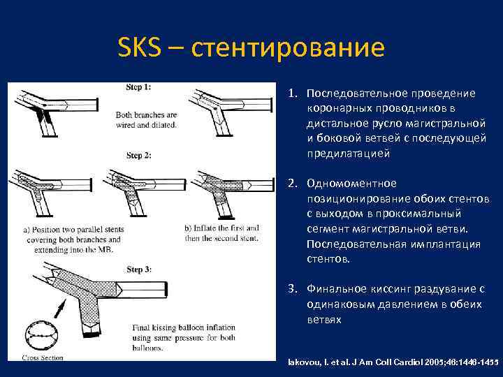 SKS – стентирование 1. Последовательное проведение коронарных проводников в дистальное русло магистральной и боковой