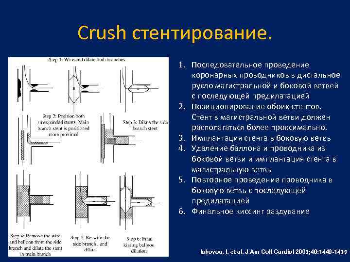 Crush стентирование. 1. Последовательное проведение коронарных проводников в дистальное русло магистральной и боковой ветвей