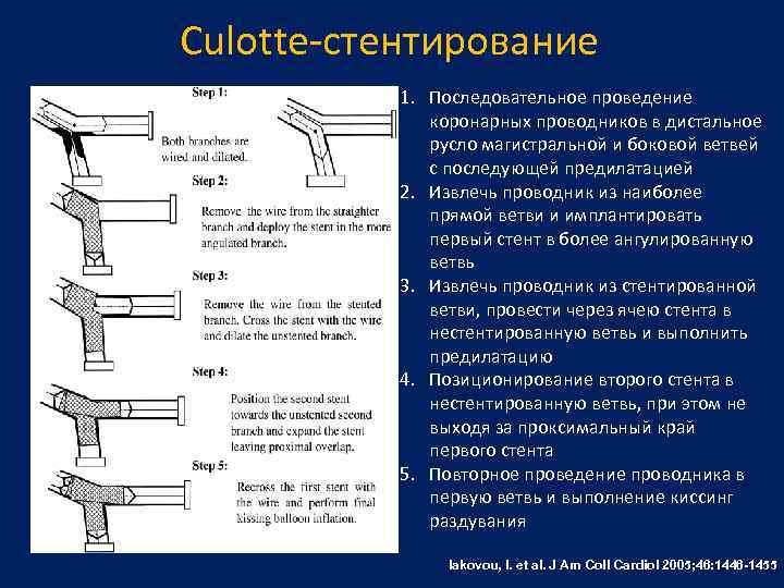 Culotte-стентирование 1. Последовательное проведение коронарных проводников в дистальное русло магистральной и боковой ветвей с