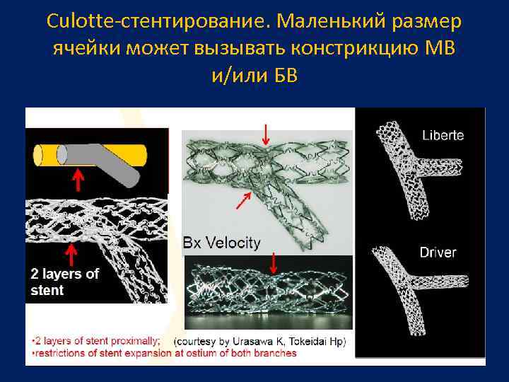 Culotte-стентирование. Маленький размер ячейки может вызывать констрикцию МВ и/или БВ 